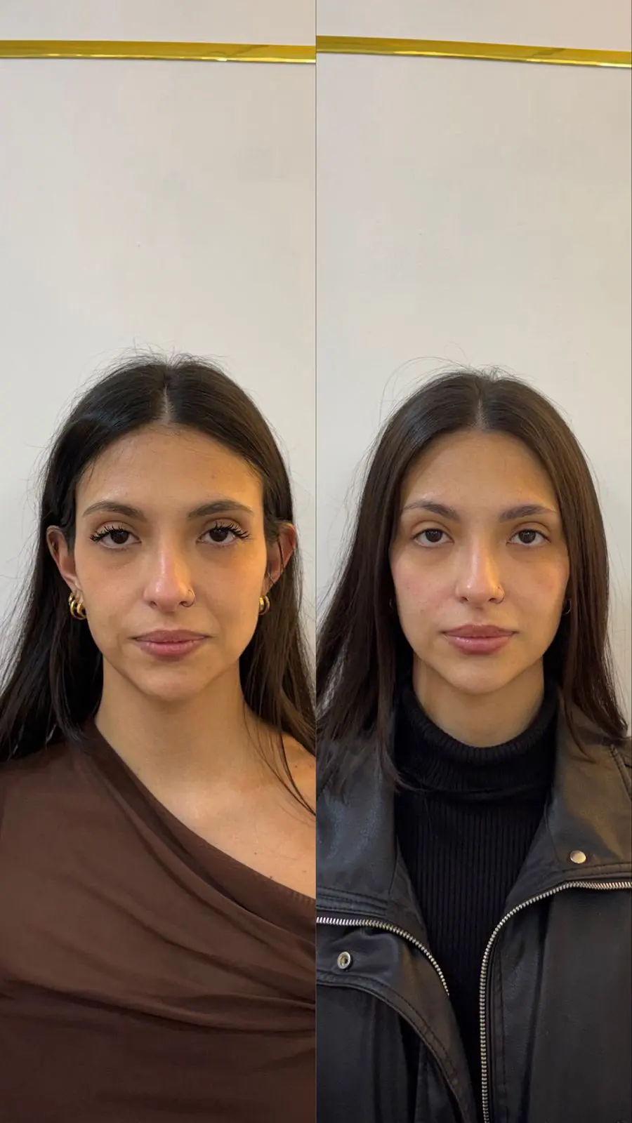Resultado 2: foto de antes e depois do tratamento de uma paciente