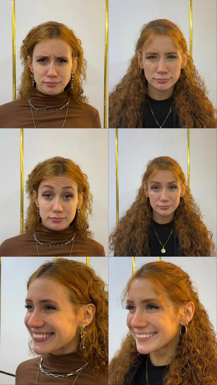 Resultado 4: foto de antes e depois do tratamento de uma paciente